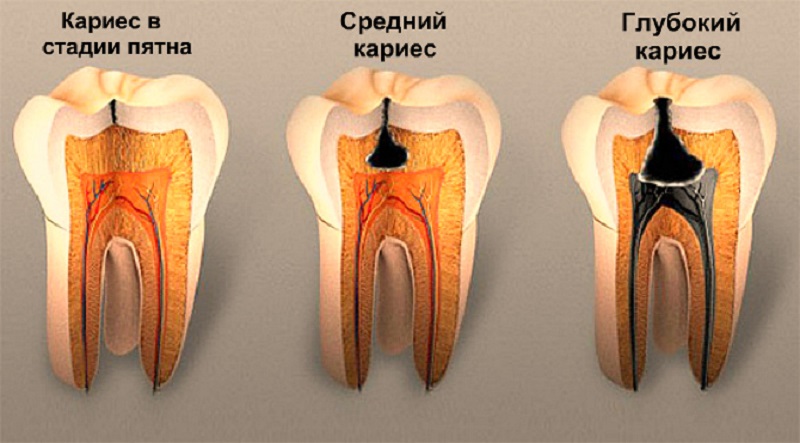 Причины образования кариеса зубов